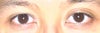 My uneven eyelids