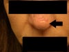 blister on nose tip