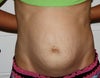 before tummy tuck