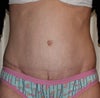 6 months after - it actually looks a lot worse than it shows in the picture