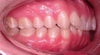 Before my teeth were straight..This is the right side of my mouth, and naturally my bite on this side lines up ok.