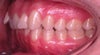 Before my teeth were straight, but the over bite/overjet looks about the same.So I have one side that the teeth fit correctly, and one that does not.