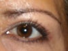view of both eyes at 6wks post op