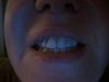 the tooth slightly longer is the one compromised. The crown needs to come off and a implant needs to be inserted