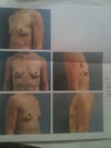 PRE SURGERIES
