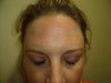 Melasma: Forehead and cheeks