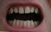 I have spacing and an overbite and I want to do something about it.