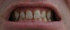 I don’t really want to spend many years in Invisalign as I am 38 now.