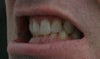 would love to have spaces close more than anything and teeth lined nicely.