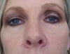 Midface - laxity under eyes and nostril asymmetry, wrinkling on bridge of nose between eyes