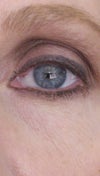 Eye - under eye skin wrinkling and laxity