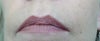Mouth - naso-labial fold wrinkling