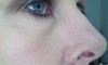 Nose and eye - wrinkling and laxity under eye, scar (2") and broken capillaries on nose