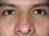 Front picture before procedure