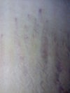 dark/thick stretch marks