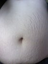 white/thin stretch marks