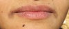 Angular cheilitis