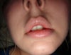 this is me now , after my 2nd fat transfer fixed my cheek area , my mouth area was not treated by my new doctor, not yet, here you can see  the issue of my lips/mouth area being turned outwards, what can be done to correct them? (when i smile my upper lip turns itself almost outwards.. and my mouth and lip area is saggy (from the first f/t surgery)