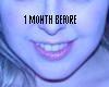 this is me back in March of 2009, you can see my hollow lower lids and the way my lips looked like before i had the surgery