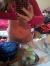 18days post op