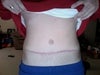 10 wks post op. Surgery performed by a board certified surgeon. highly disappointed in my incision...