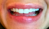 1 noticeable bump on the top (but I can feel 4) and 2 on the bottom, one if which is really large.