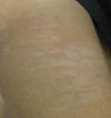 1 MONTH after IPL hair removal