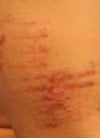 2 WEEKS after IPL Hair removal