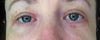 crease under left eye (right in picture)