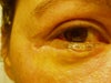 Left eye incision