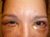 Both eyes after surgery