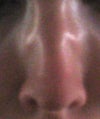 Nose pre-revision (strongly inhaling to show contour)