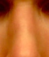 Nose post-revision (strongly inhaling to show contour)