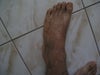 left foot (a lot more hyperpigmentation than right foot)