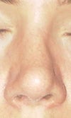the cartilage graft makes my nose look very crooked