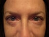 11/16/11 before shots for inflammation the next day