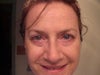 12/29/11 Assymetry, rings under eyes more pronounced. Uneven lids, outer eye by incision is indented in, not smooth with cheek like it was before.