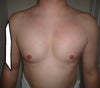 21 days post-op