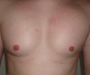 21 days post-op