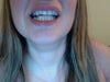 With my mouth open you can clearly see how off the bottom teeth are.