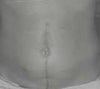 the old scar that was just fixed