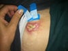 Open ... right after starting antibiotics