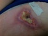 starting to heal