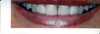 Space between two front teeth and veneers on either side.