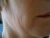 LIP WRINKLES AND CHEEKS
