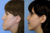 Orthognathic Surgery Before and After Photos