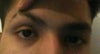 tried pulling my eyelid a bit.looks great.seems i have pulled too much but had no problem in closing my eyes while doing this.