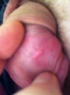 raised scar under forskin