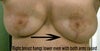 Right breast feels heavy and hangs much lower and sags toward my armpit even with my arms raised. The R implant is so  squishy I can't feel the outline of the shell. The left implant is discernable by feel and the breast feels perky.