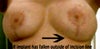 This shows where the implant is gradually (over 6 months) dropped below its original position and fallen below the incision line.